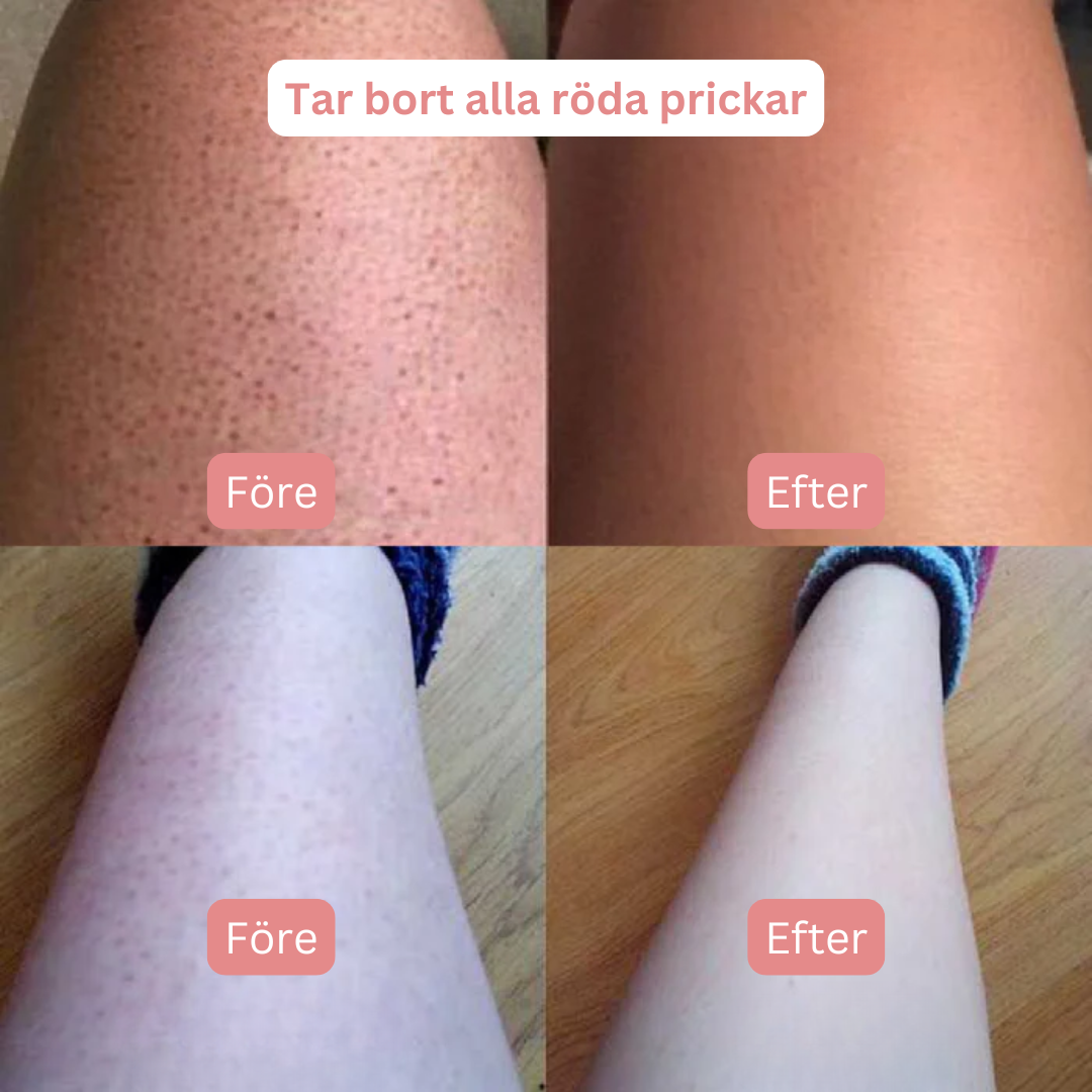 Bye bye röda prickar